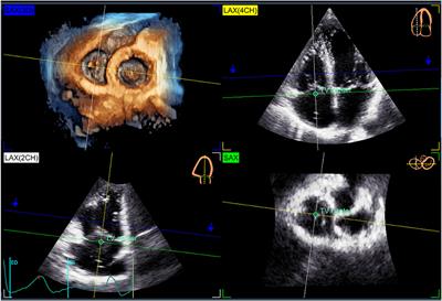 Reference ranges of tricuspid annulus geometry in healthy adults using a dedicated three-dimensional echocardiography software package